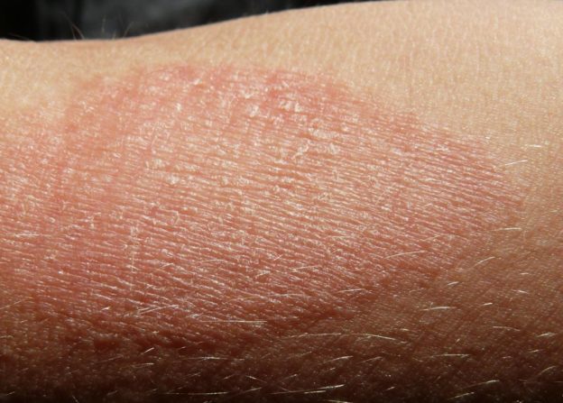 eczema-i-the-woodruff-institute-for-dermatology