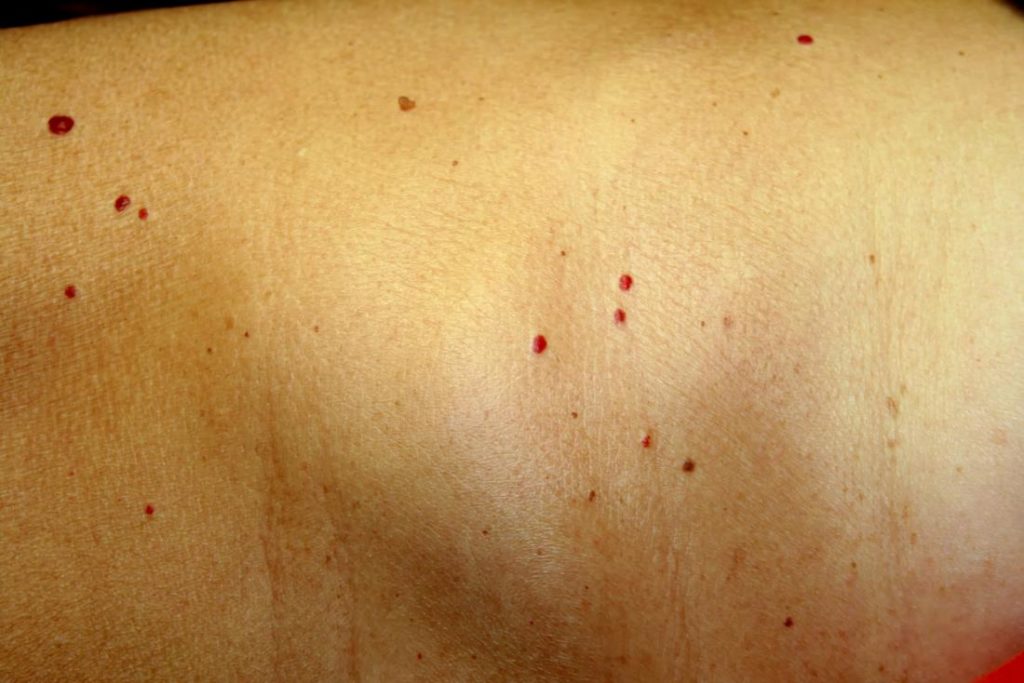 angioma-i-woodruff-institute-for-dermatology